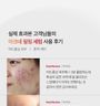 Red Acne Succinic Acid Peel