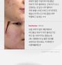 Red Acne Succinic Acid Peel
