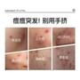 Azelaic Acid Acne Removing Gel