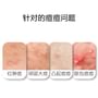 20% Azelaic Acid Acne Treatment Gel