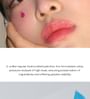 Diamond Drop Blemish Patch
